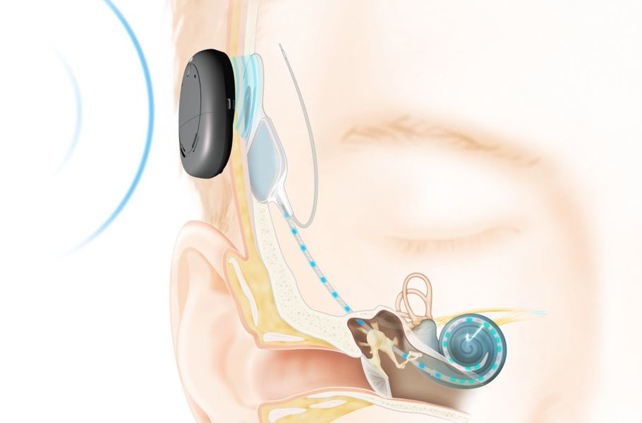 Слуховой аппарат внутреннего уха. Аппарат Cochlear кохлеарный. Кохлеарная имплантация Cochlear 7. Рондо 3 кохлеарный имплант. Слуховой аппарат Сименс моушен 500 внутриканальные.